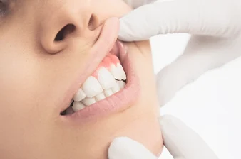Behandlung Zahnfleischentzündung